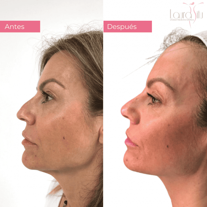 Rinomodelacion barcelona clinica medicina estetica Dra. Laura Sitú