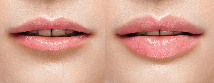 aumento de labios muy finos