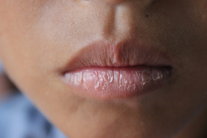 labios secos