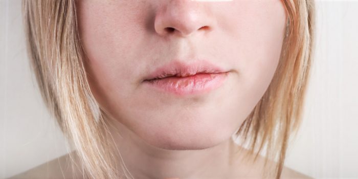 queilitis labios