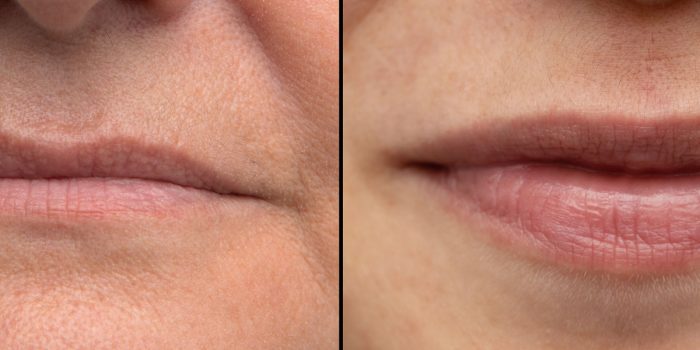 pérdida de volumen por envejecimiento