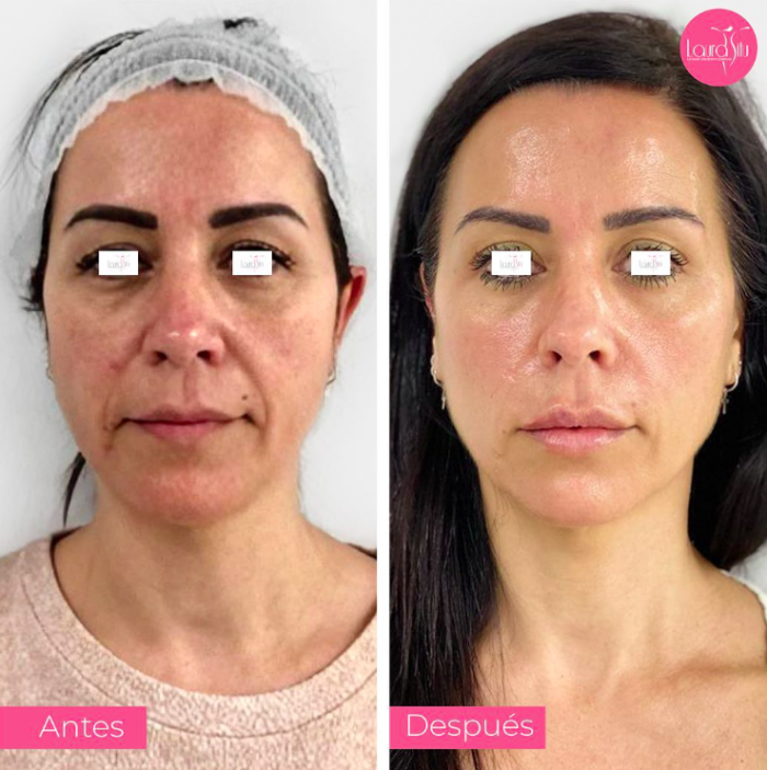 Rejuvenecimiento Facial Barcelona Dra. Laura Sitú