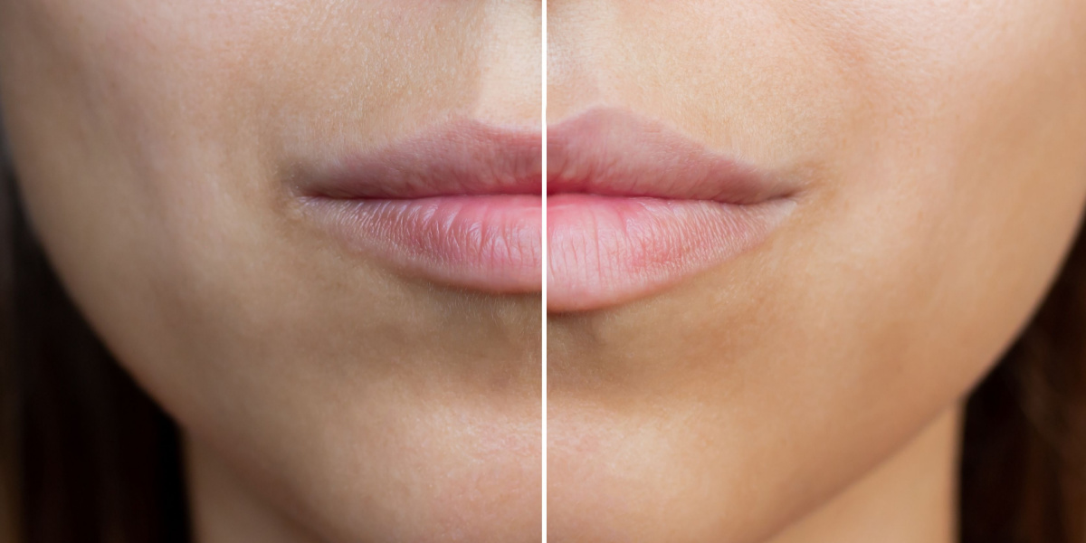 cómo agrandar los labios