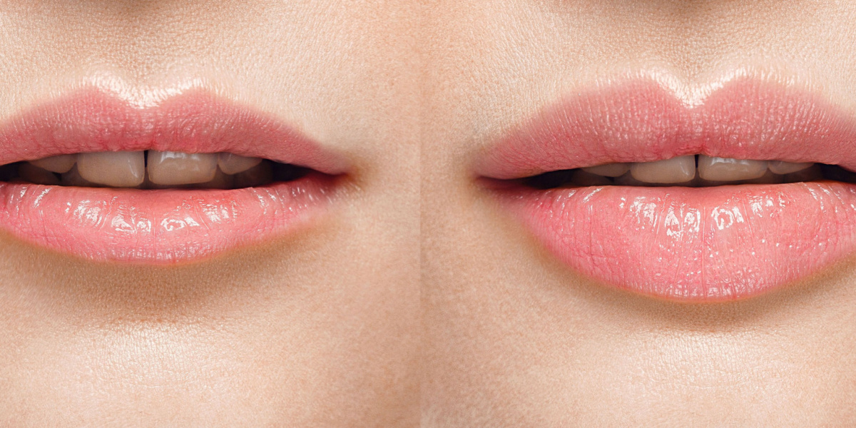 cómo elegir el tamaño de labios en un aumento