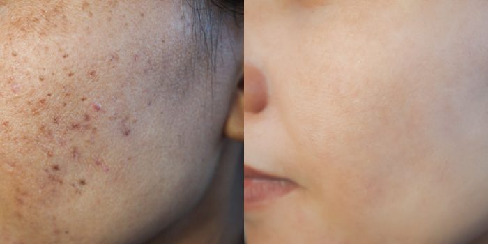 cicatrices de acné