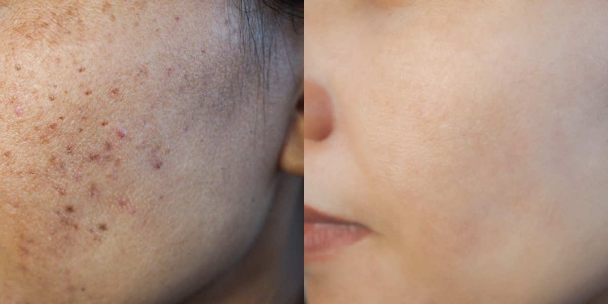 cicatrices de acné