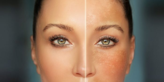 hiperpigmentación postinflamatoria