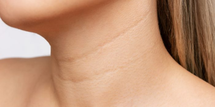 anillos de venus en el cuello