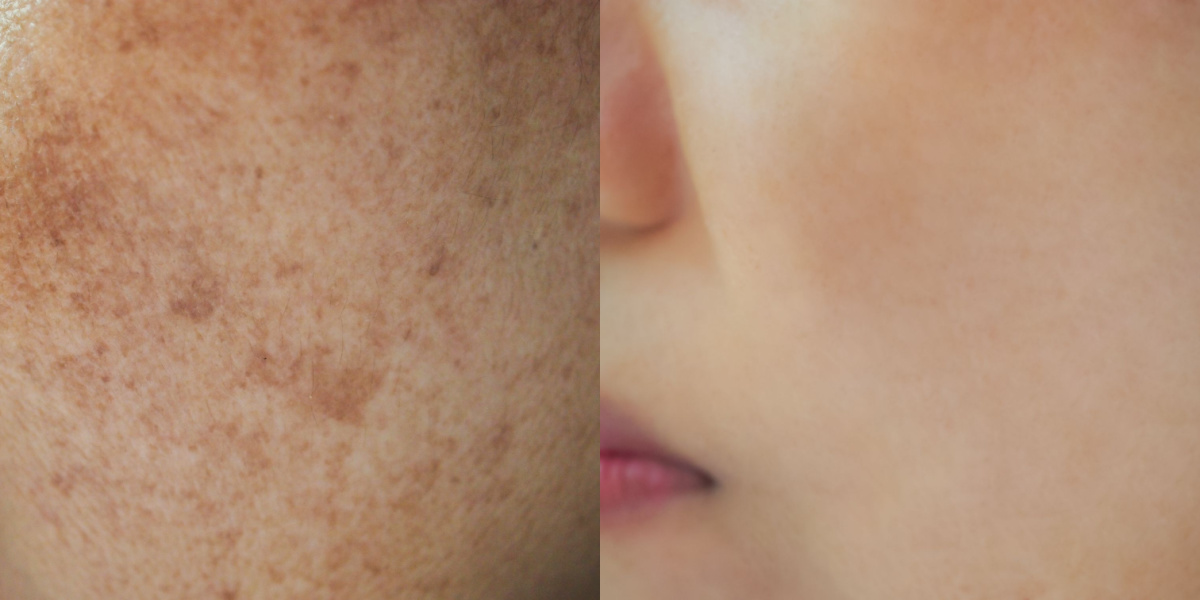 melasma