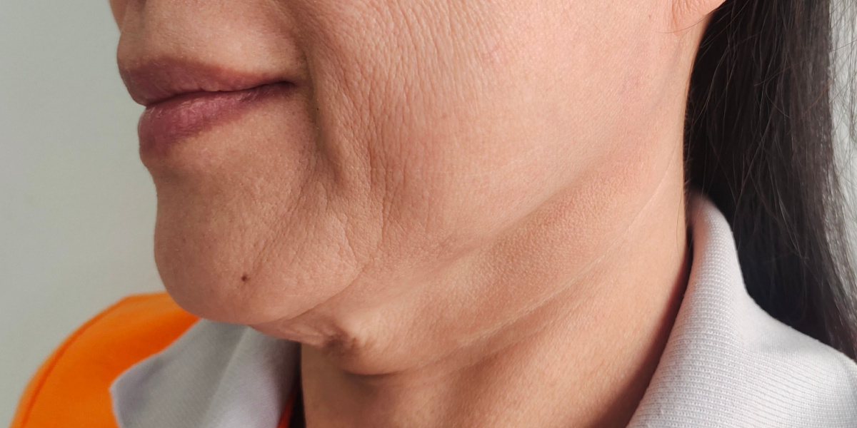 descolgamiento facial