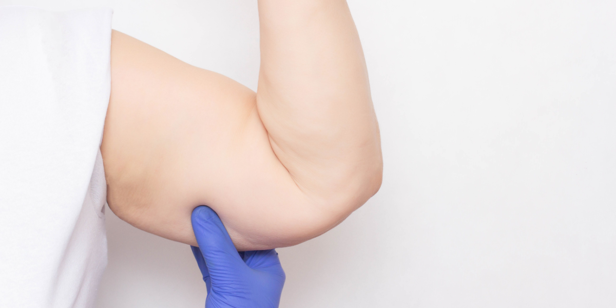 flacidez en los brazos