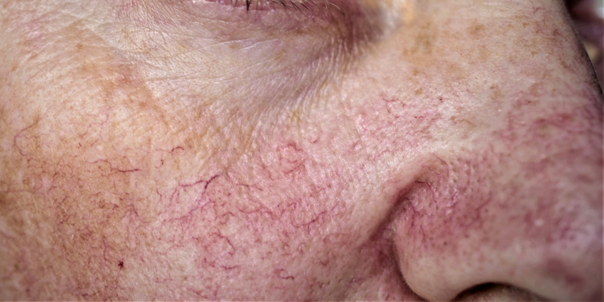 telangiectasias
