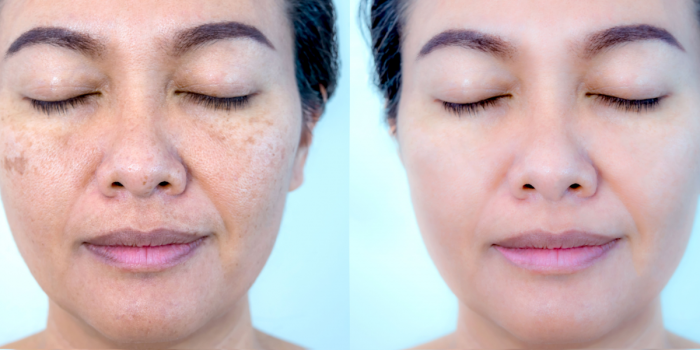 uniformidad del tono de la piel