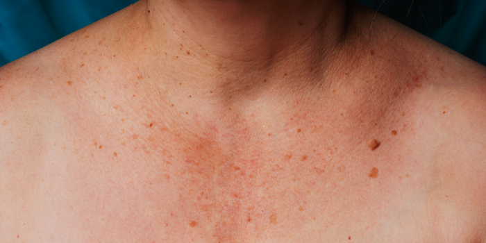 manchas en el escote