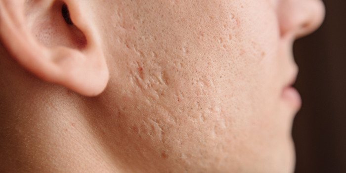 tipos de cicatrices de acné