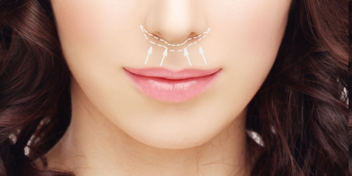 acortamiento del labio superior