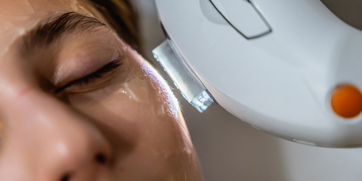 Es adecuada la IPL para todos los tipos de piel