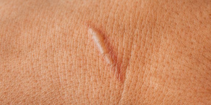 cicatrices quirúrgicas