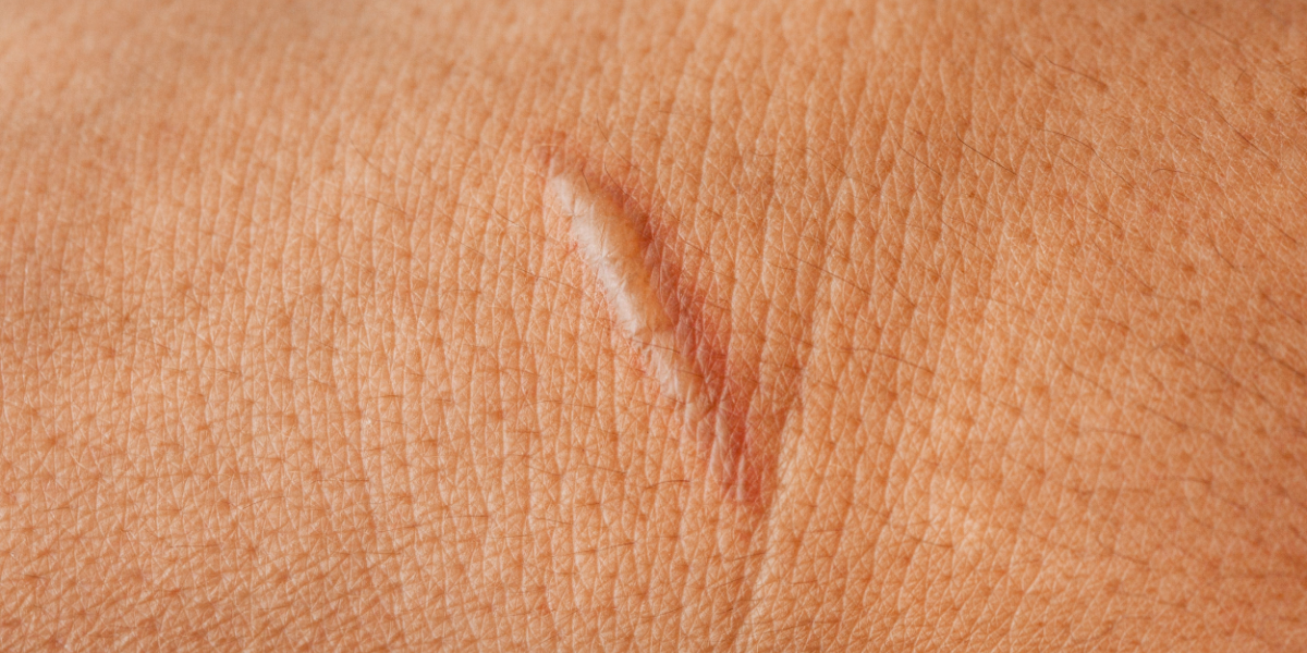 cicatrices quirúrgicas