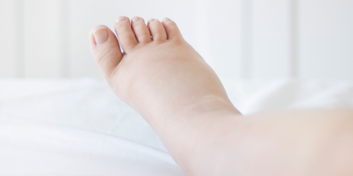 retención de líquidos