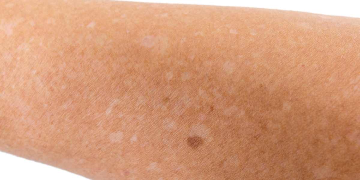 manchas blancas en la piel