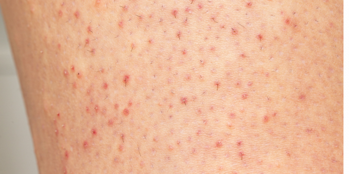 queratosis pilaris