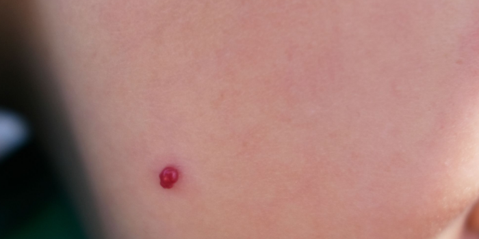 angiomas