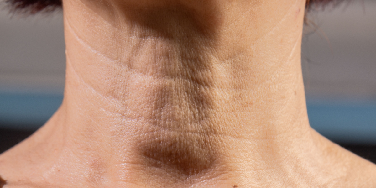 cuello arrugado y flácido