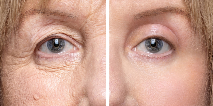 ptosis de los párpados