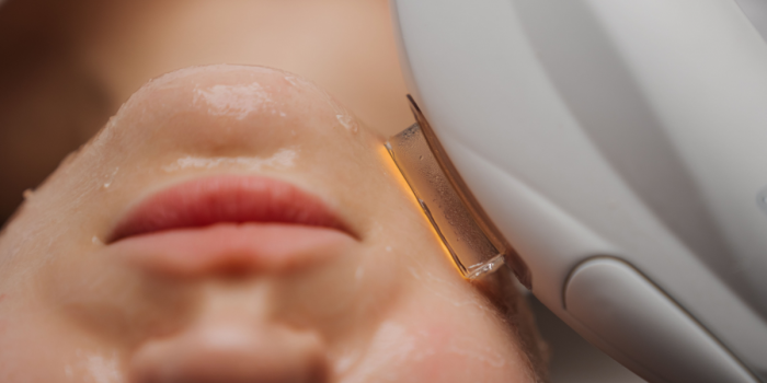 resurfacing facial
