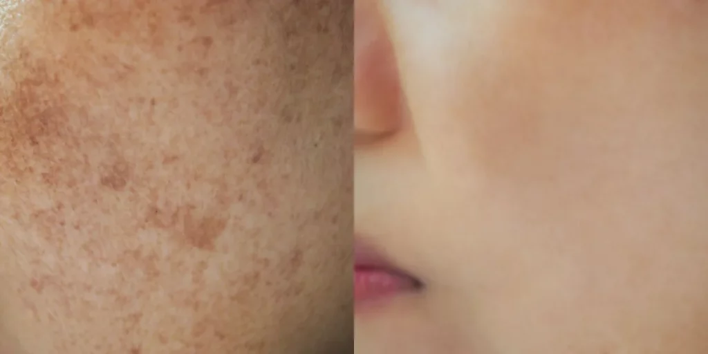 melasma antes y después tratamineto
