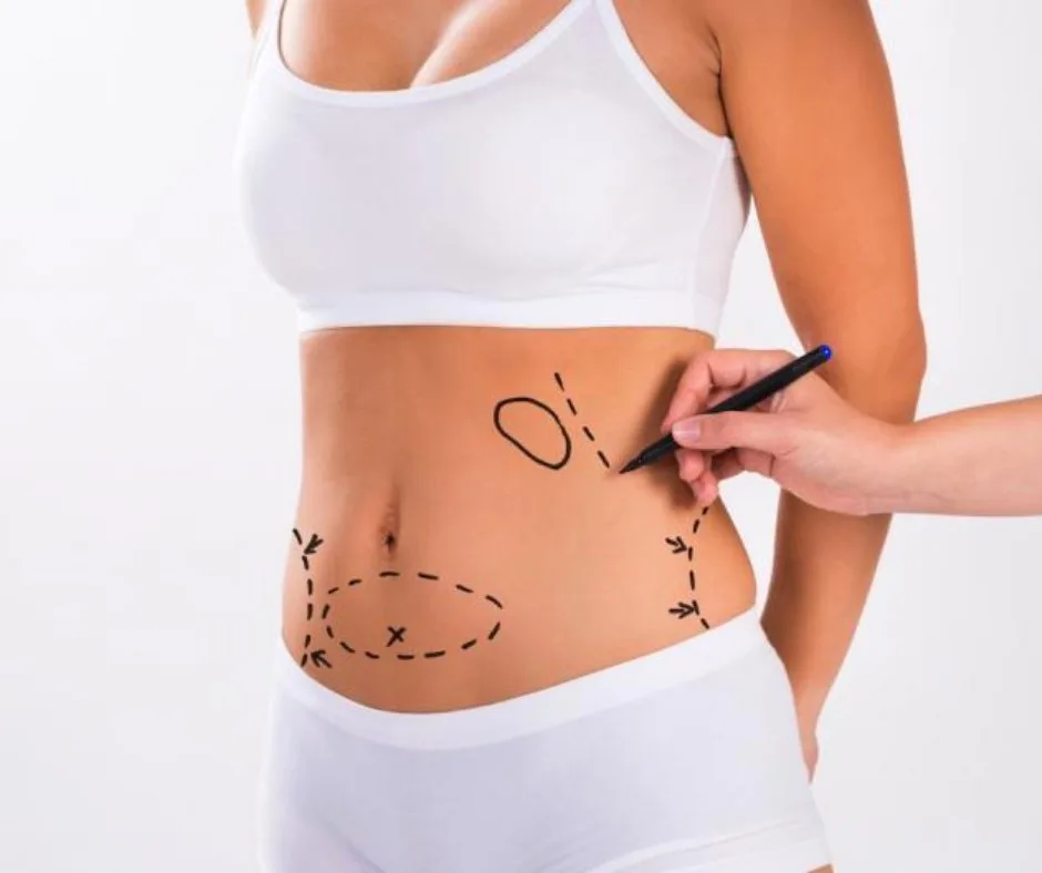 mesoterapia-laura-situ-1
