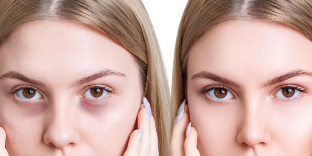 Ojeras hundidas antes y después del relleno con ácido hialurónico