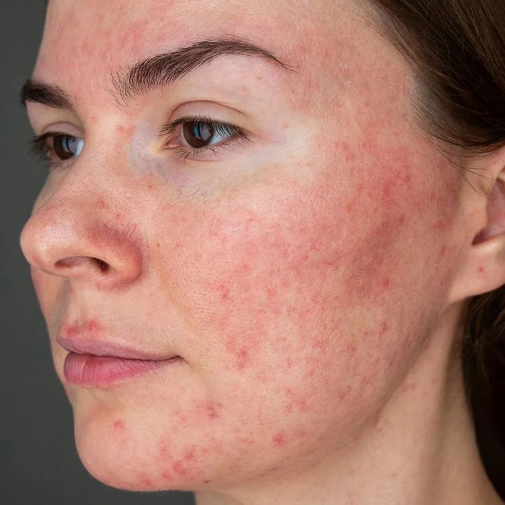chica con rosacea