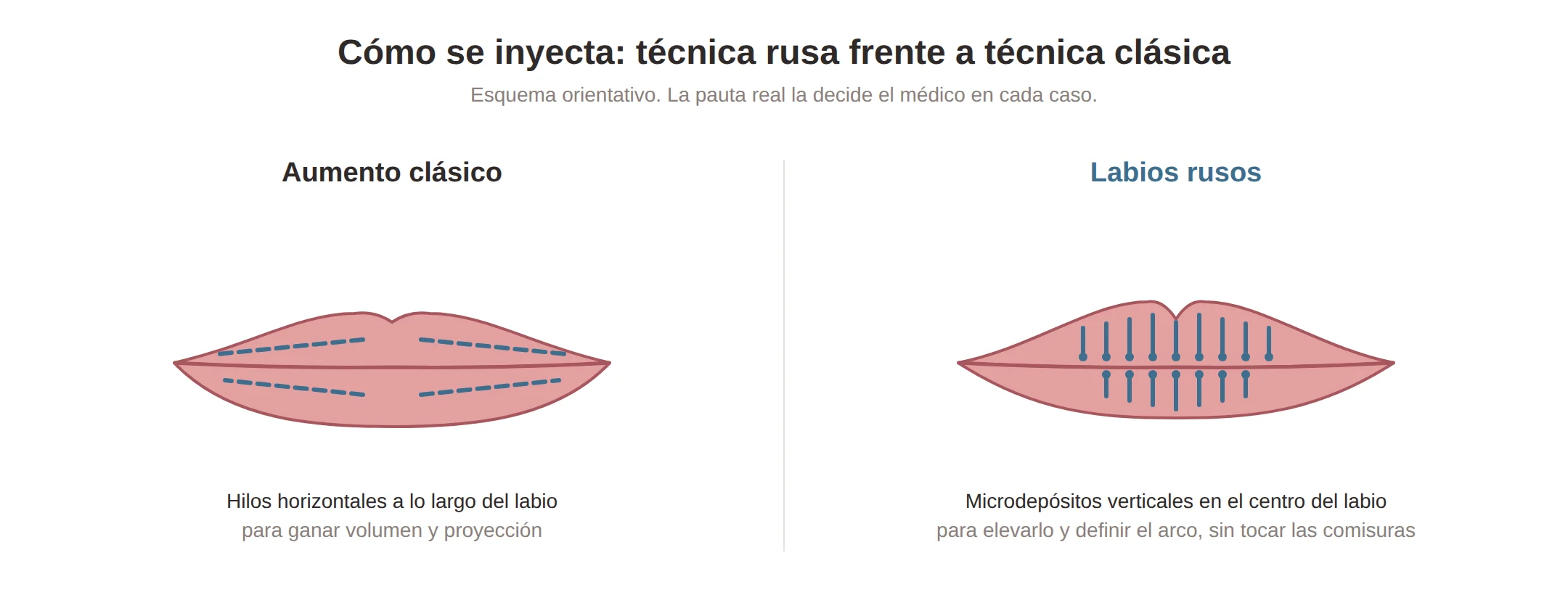 Esquema de los puntos de inyección verticales de los labios rusos frente a la técnica horizontal del aumento clásico