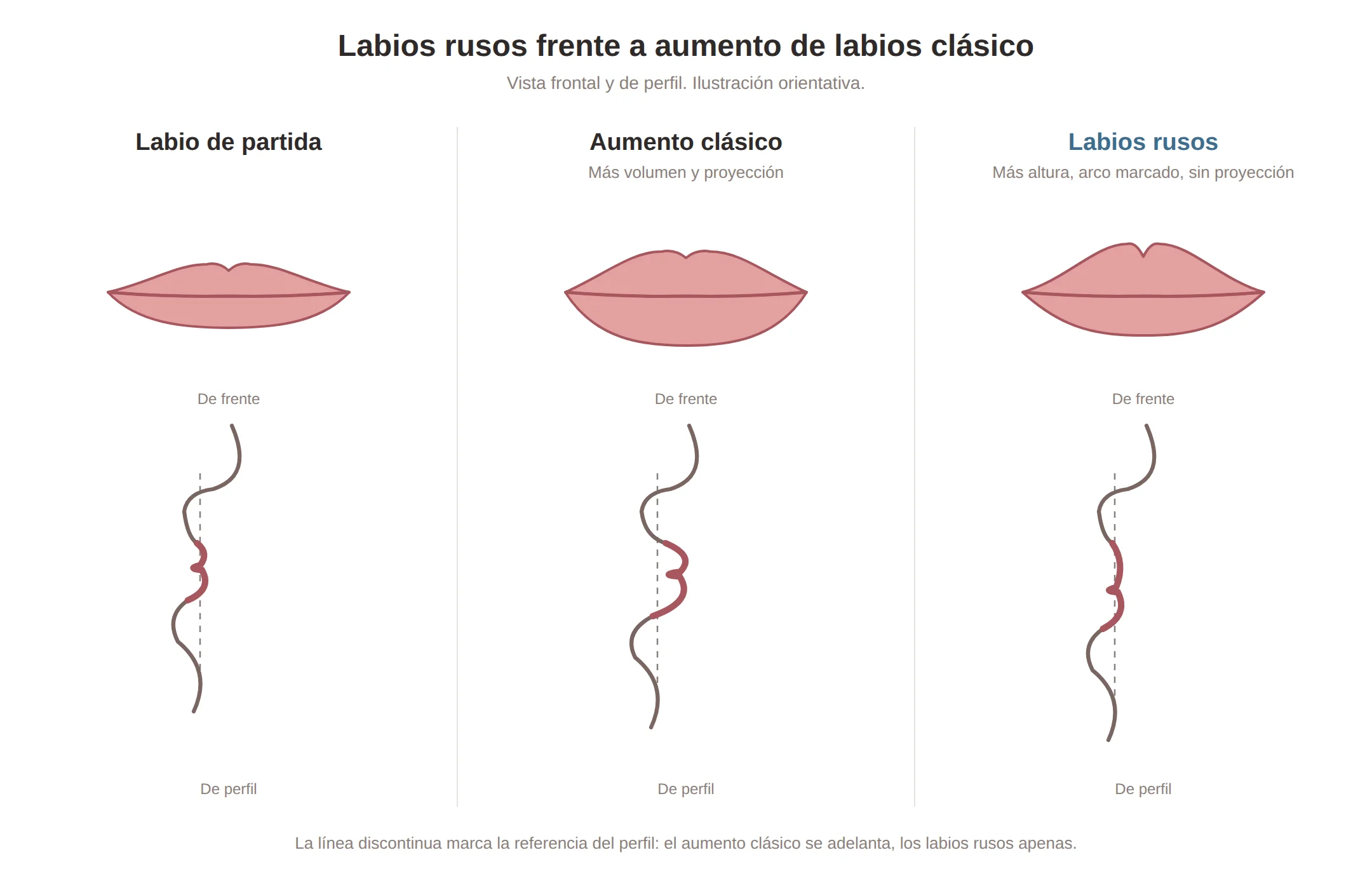 Comparación de frente y de perfil entre labio de partida, aumento de labios clásico y labios rusos