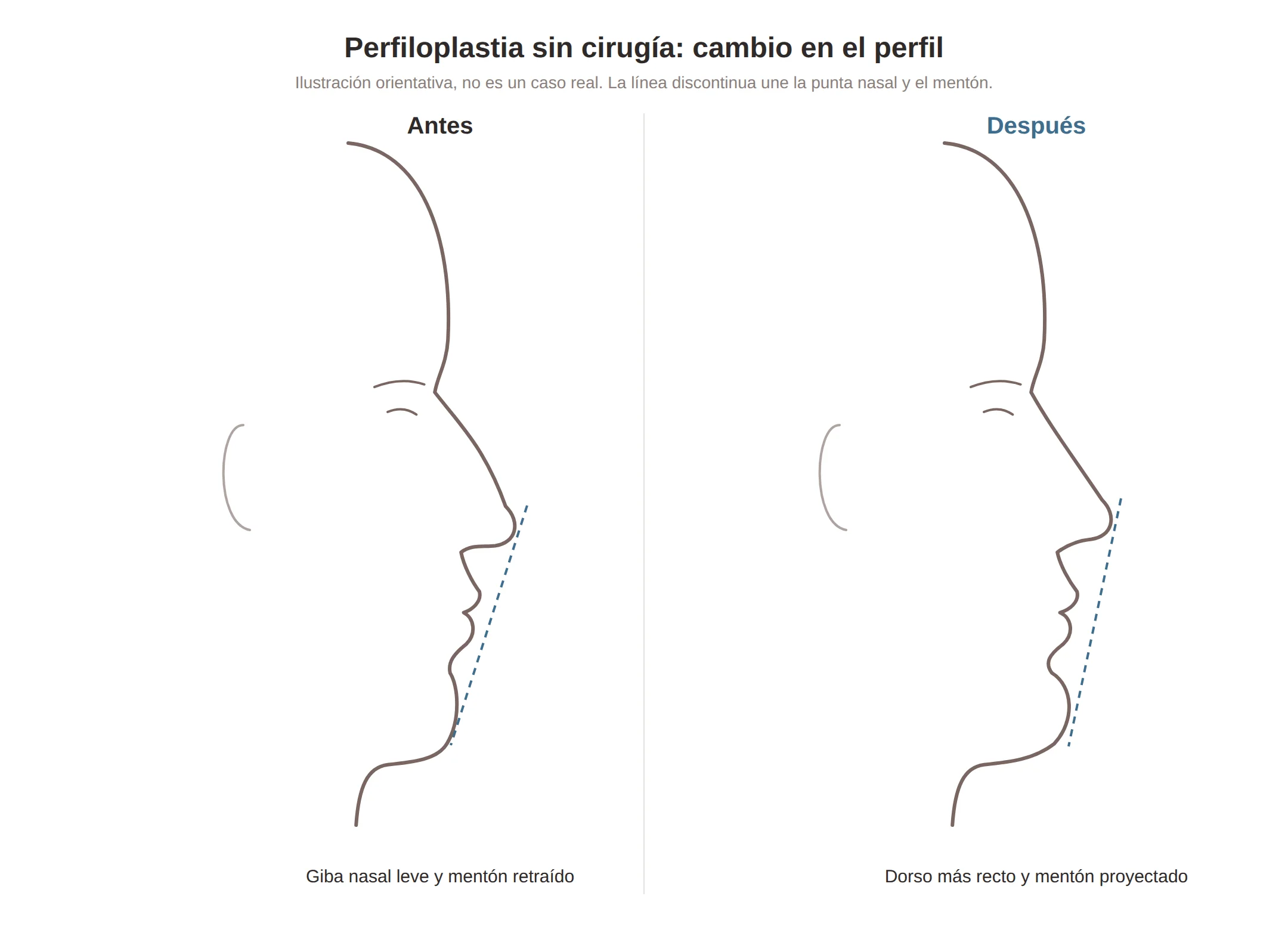 Ilustración de un perfil antes y después de la perfiloplastia sin cirugía con la línea estética entre nariz y mentón