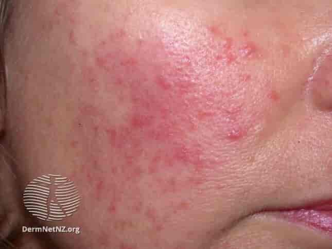 rosacea detalle