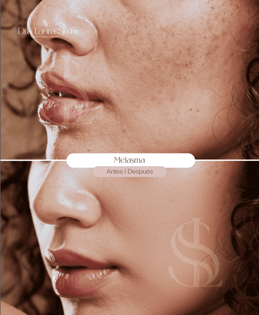tratamiento melasma. antes y despues