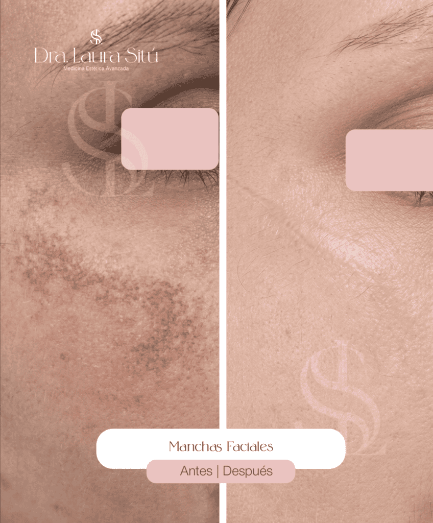 tratamiento manchas en cara. antes y despues