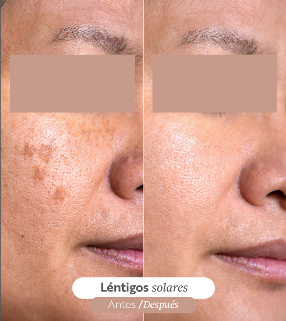 tratamiento lentigos solares. Antes y después.