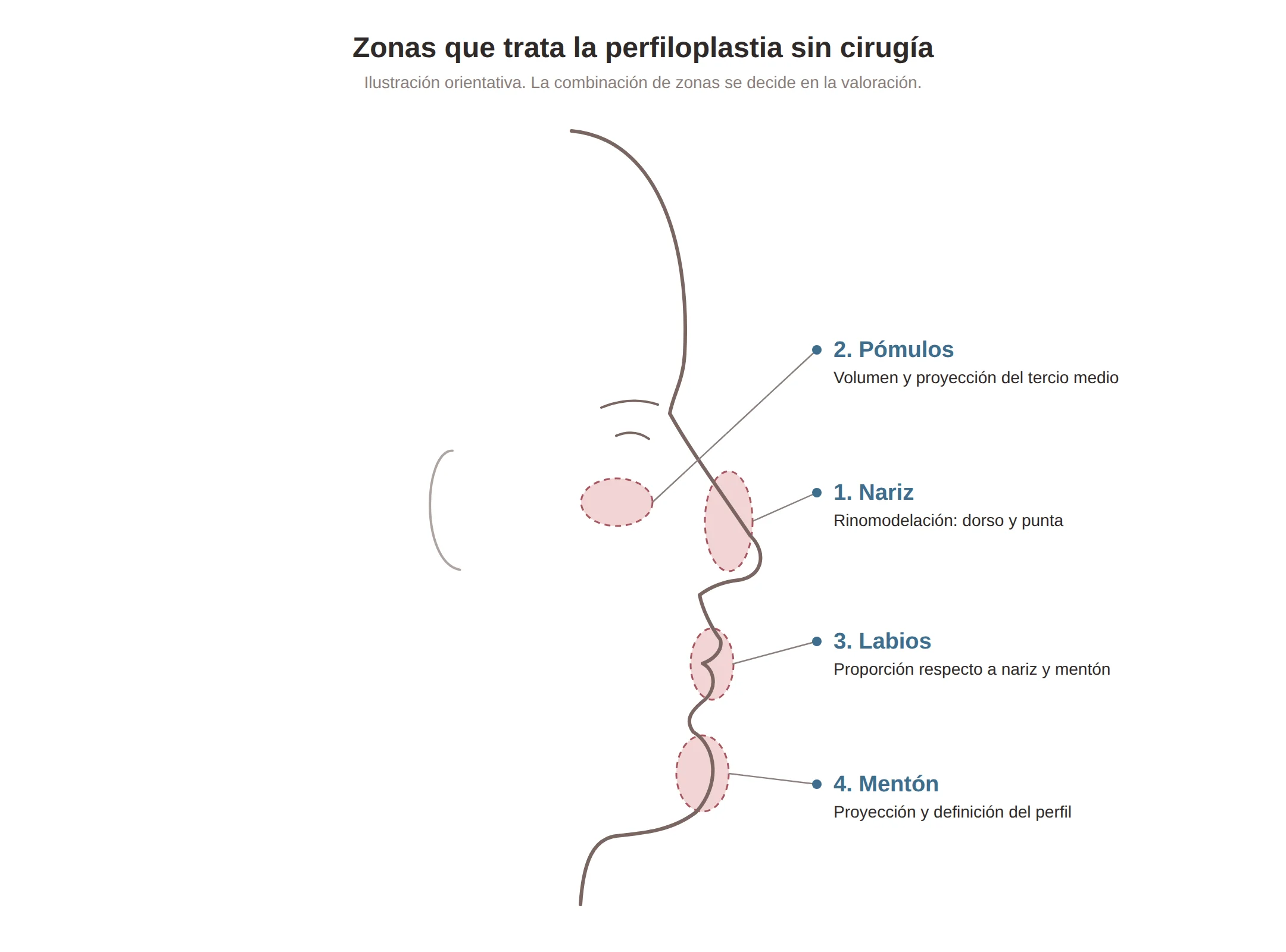 Zonas que trata la perfiloplastia sin cirugía: nariz, pómulos, labios y mentón