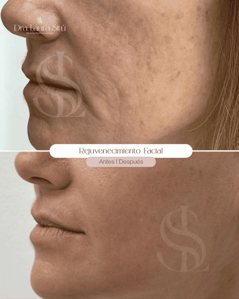 rejuvenecimiento facial antes y despues. dra. laura situ